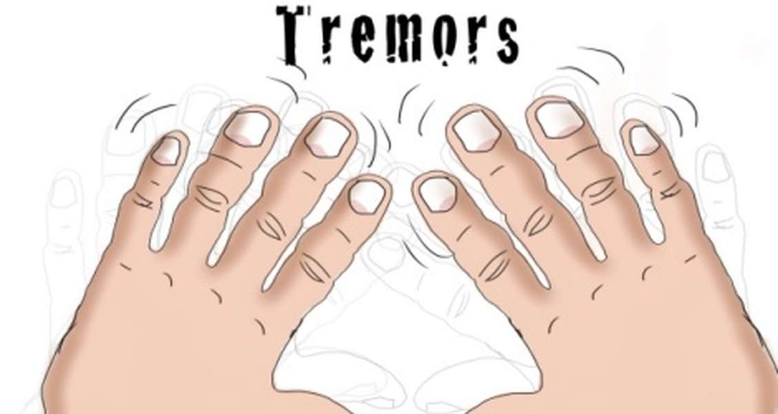 Essential tremor - Hình ảnh minh họa